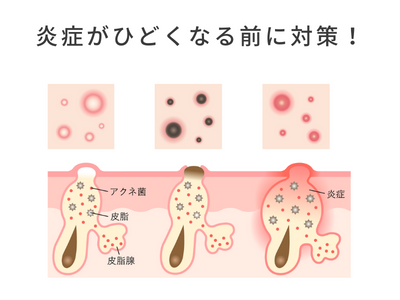 ニキビ 炎症