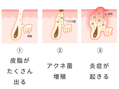 ニキビ メカニズム