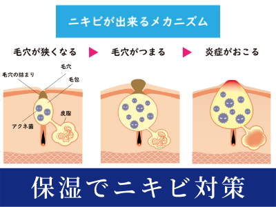 ニキビ 治す
