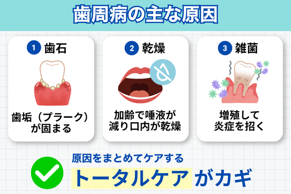 歯周病の原因と対策（歯石・乾燥・菌・炎症）を示すイメージ