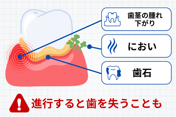 歯周病の進行サイン（出血・腫れ・歯石）を示すイメージ